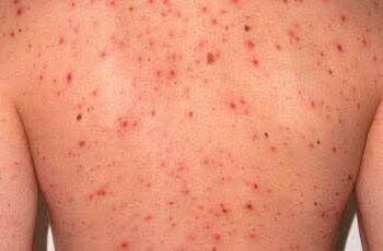 ANTE EL INCREMENTO DE CASOS DE SARAMPIÓN, EXPERTO DE LA UASLP RECOMIENDA REFORZAR VACUNACIÓN